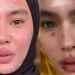 Apa Itu Sindrom Stevens Johnson Yang Diderita Artis Kartika Putri?