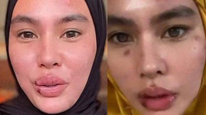 Apa Itu Sindrom Stevens Johnson Yang Diderita Artis Kartika Putri?