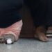 Jangan Sepelekan Penyakit Kaki Gajah, Bisa Cacat! [Waktu Baca 2 Menit]