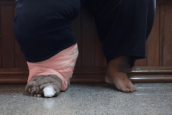 Jangan Sepelekan Penyakit Kaki Gajah, Bisa Cacat! [Waktu Baca 2 Menit]