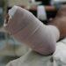 Lakukan Ini Untuk Percepat Penyembuhan Luka Lama Pada Penderita Diabetes [Waktu Baca 2 Menit]